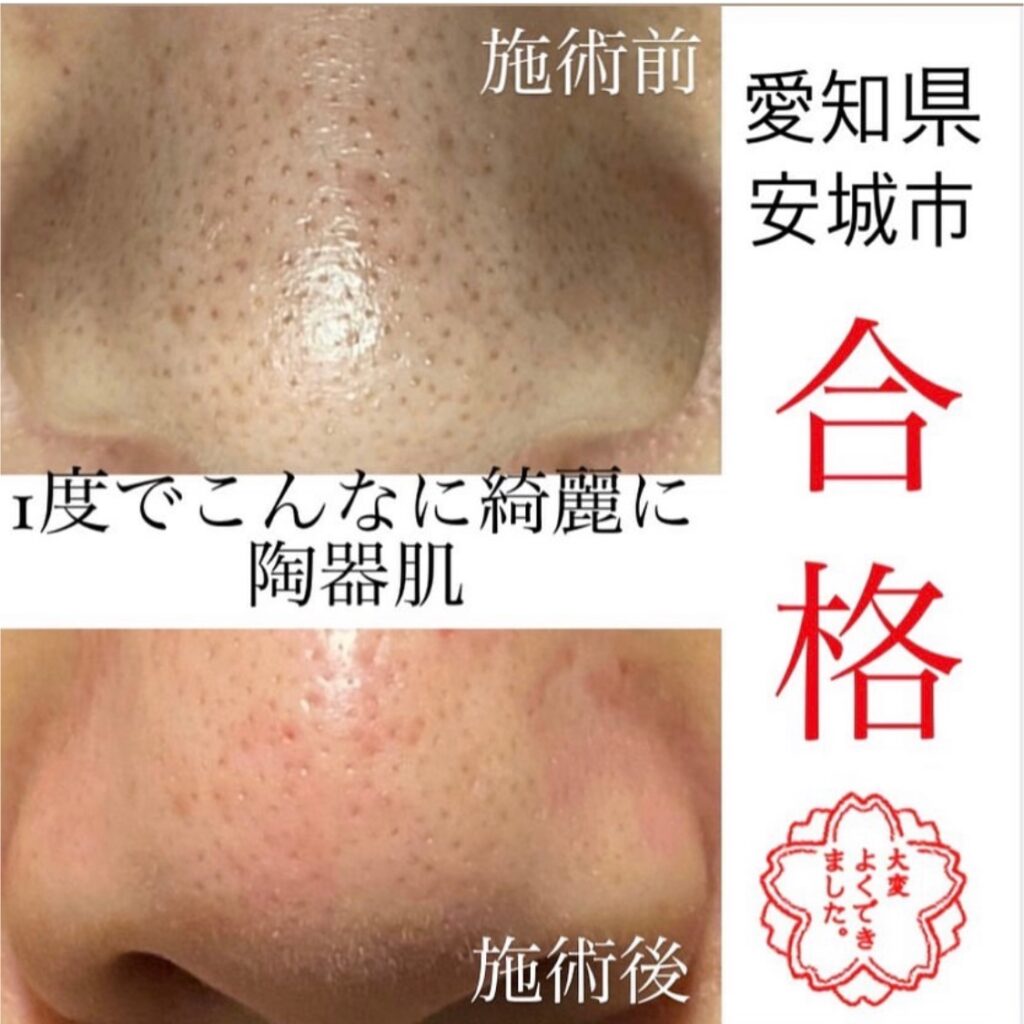 新メニュー毛穴エクストラクション | 愛知県安城市 毛穴、シミ、シワで